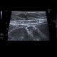 Adenomyosis of gallbladder, localized: US - Ultrasound